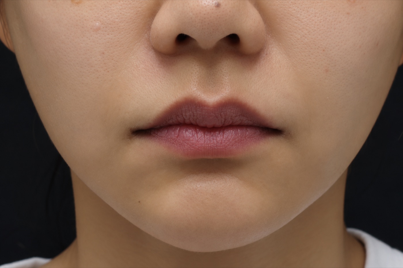 Before treatment