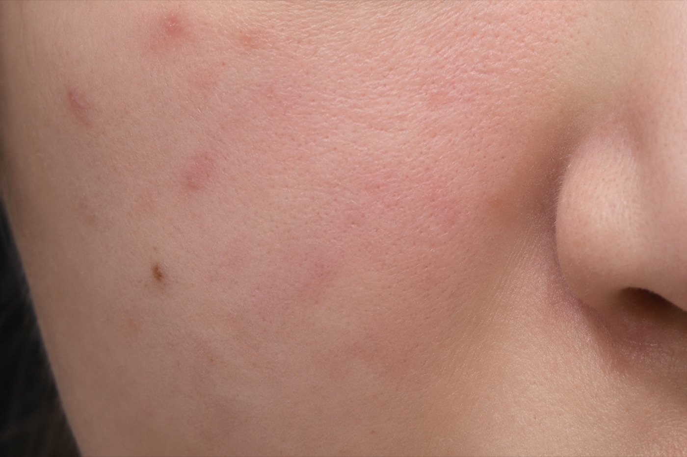 Before treatment